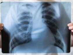 Lima Tips Terhindar Dari Tuberkulosis