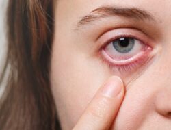 Jangan Asal Teteskan Obat, Dokter Ungkap Bahaya Mengobati Mata Merah Sembarangan