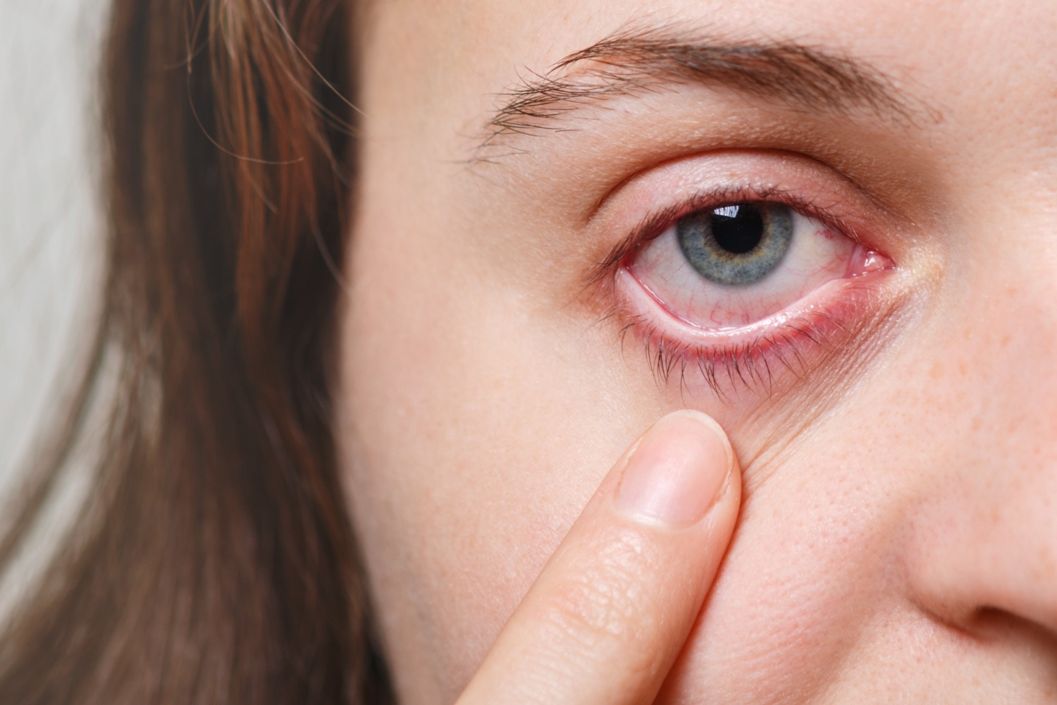 Kenali gejala konjungtivitis dan cara mencegahnya. Simak tanda bahaya mata merah serta kapan perlu diperiksa dokter spesialis.